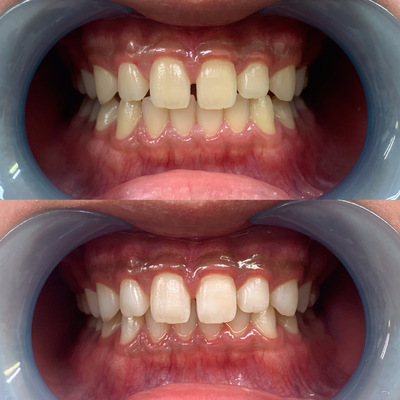 セルフホワイトニング