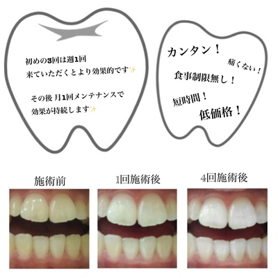 セルフホワイトニング