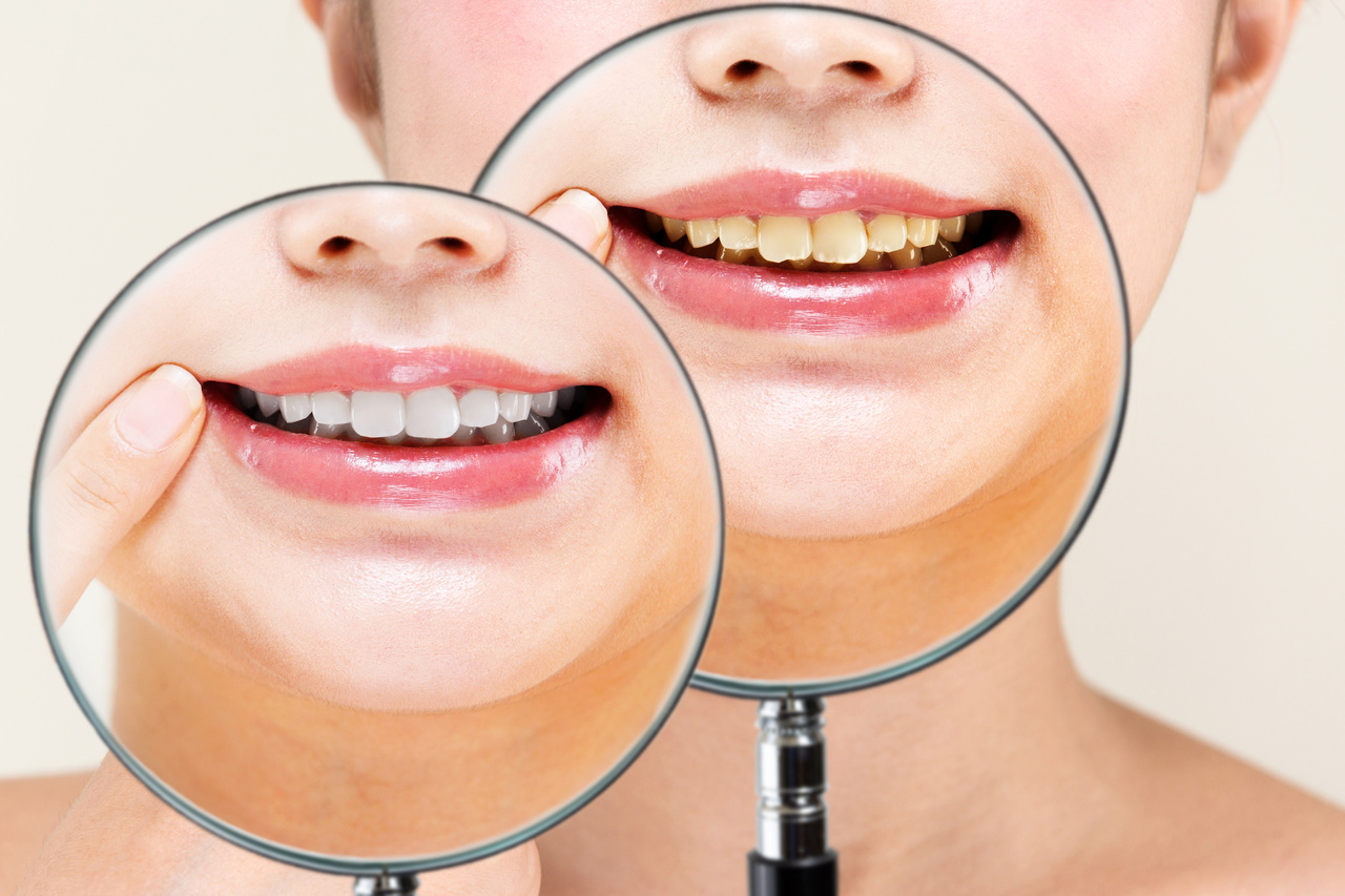 歯のセルフホワイトニングのご予約はこちら