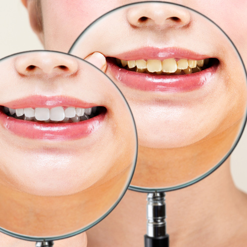 歯のセルフホワイトニングのご予約はこちら