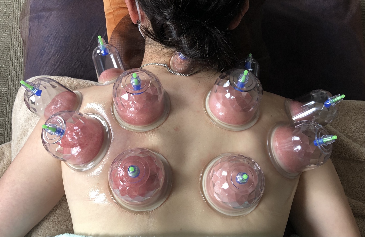 カッピング 【肩周り】