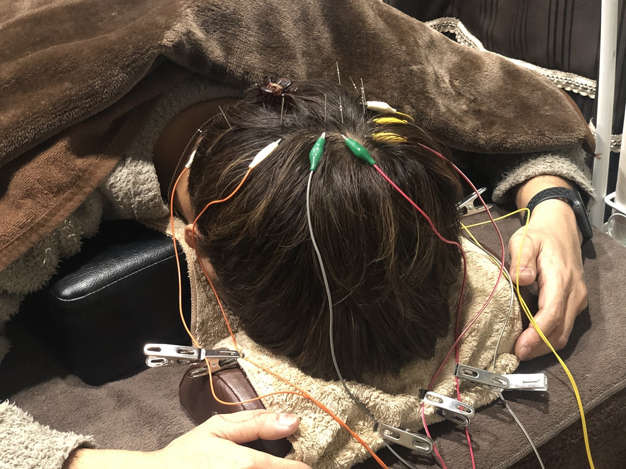 人気No.2 育毛鍼