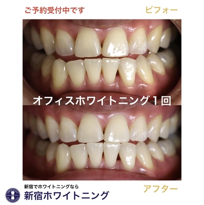 新宿ホワイトニング予約サイト　ご予約は無料です