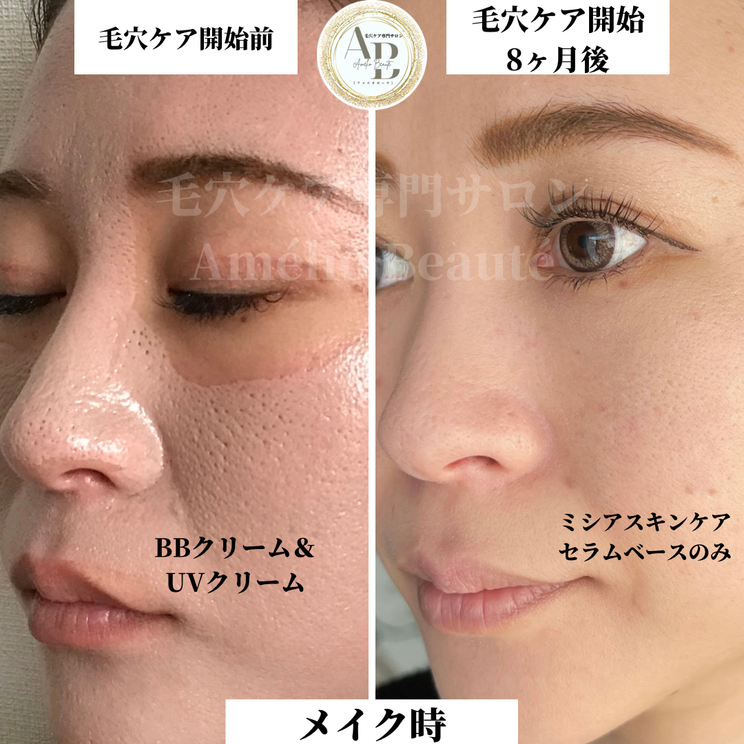 ◇毛穴ケア・肌質改善メニュー◇