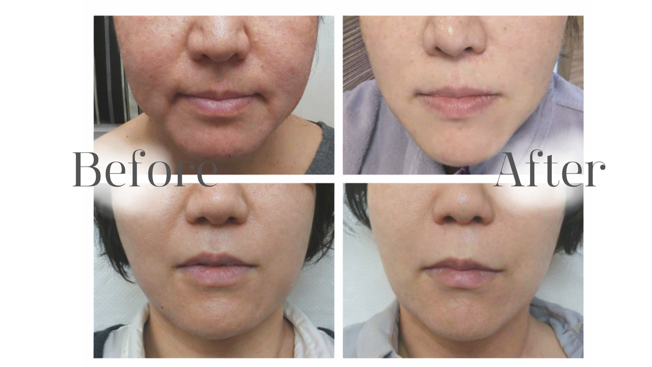 顔つぼエステ/珪素トリートメント