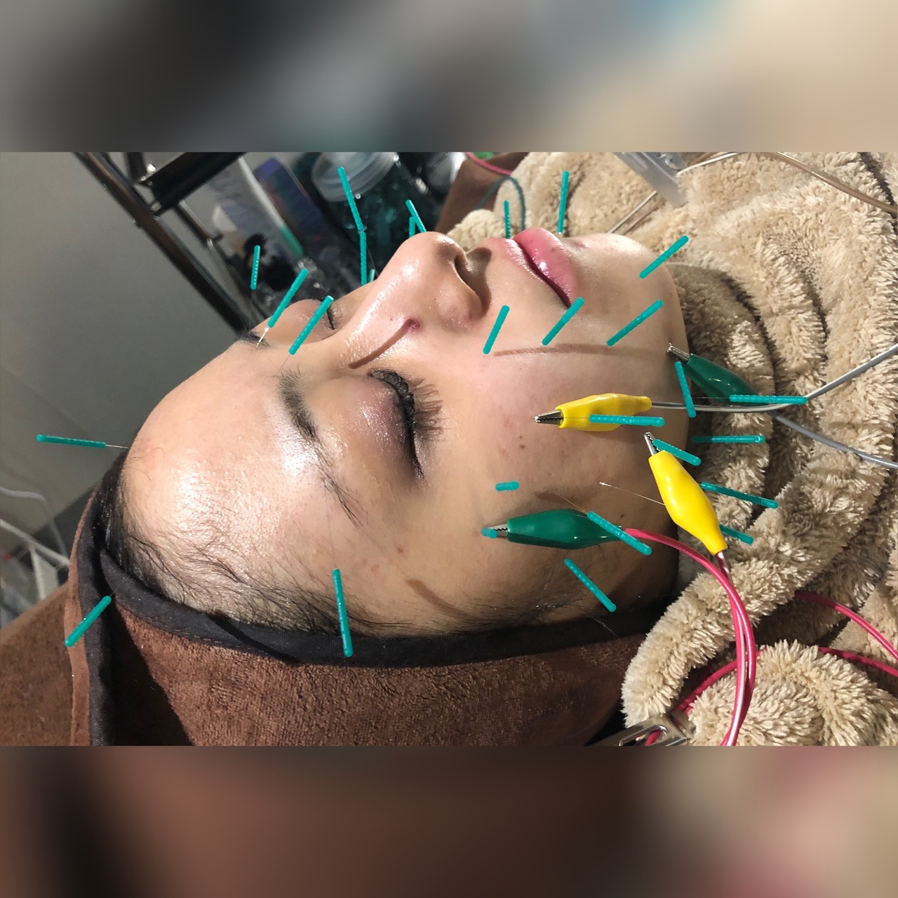 人気No.1パルス美容鍼